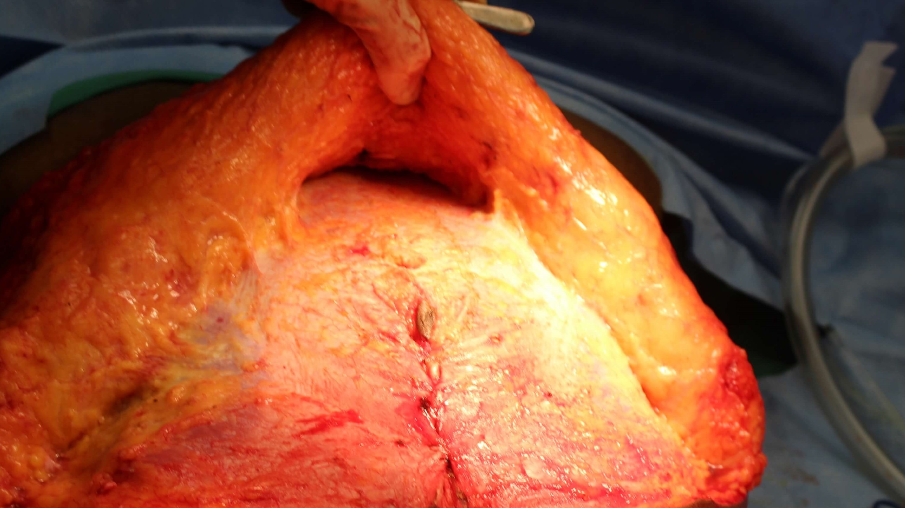Intraoperative photo of diasta